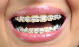 clear braces- watford dental