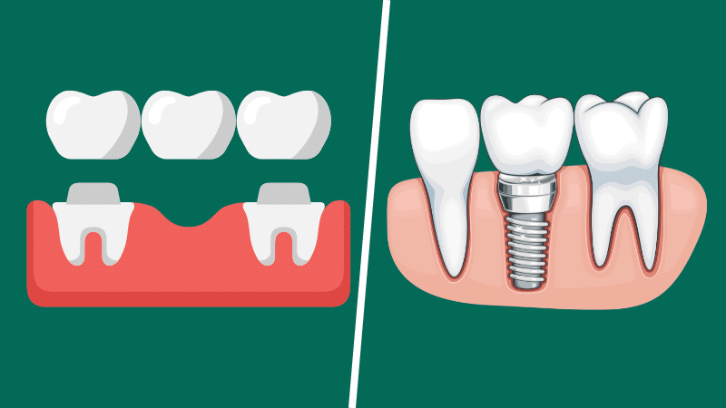 fixed bridges vs dental implants which is better for damaged teeth